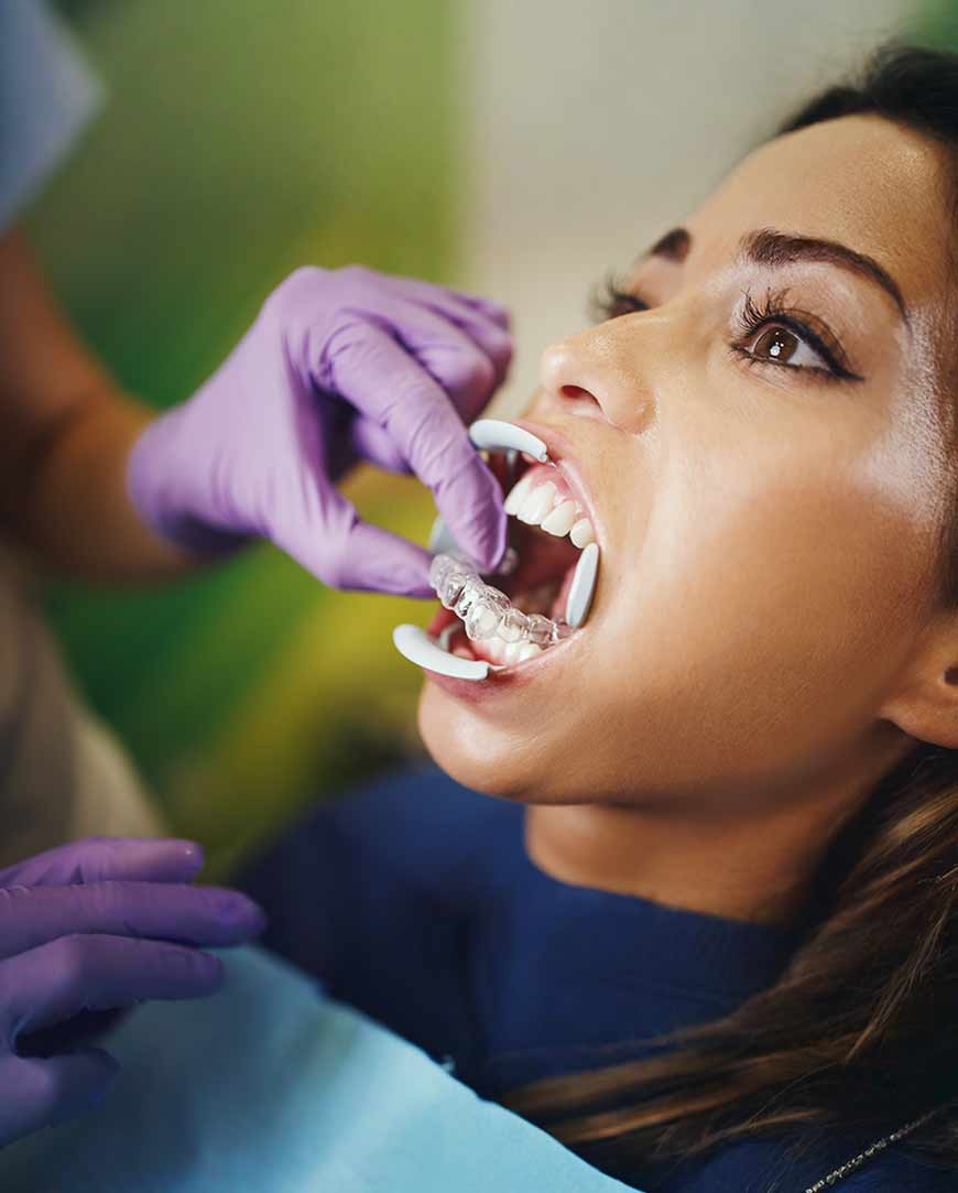 Clear Aligners in Kolkata | Orofacial Polyclinic 