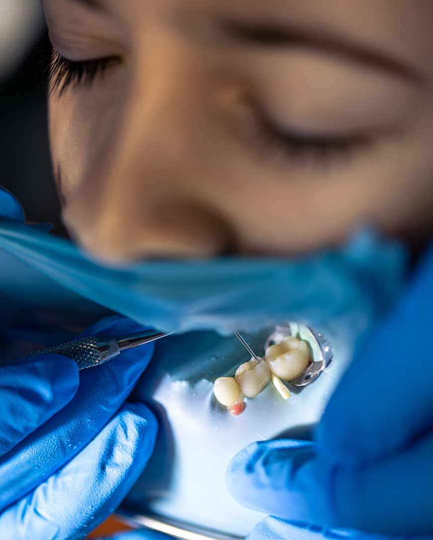 Wisdom Teeth Removal in Kolkata | Orofacial Polyclinic 